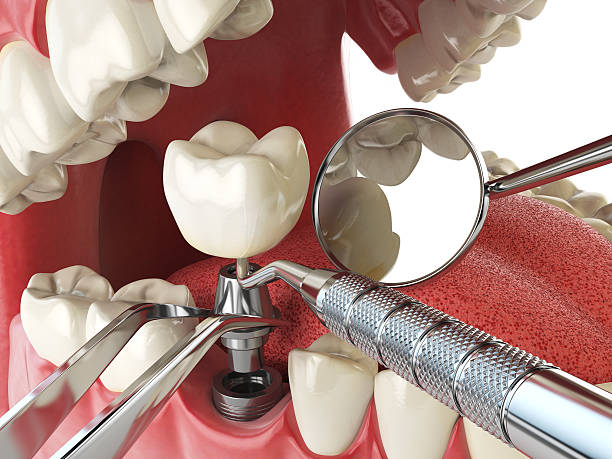 Best Broken or Chipped Tooth Repair in Country Clu, FL